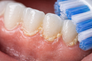 primer-plano-cerdas-cepillo-dental-eliminando-placa-bacteriana